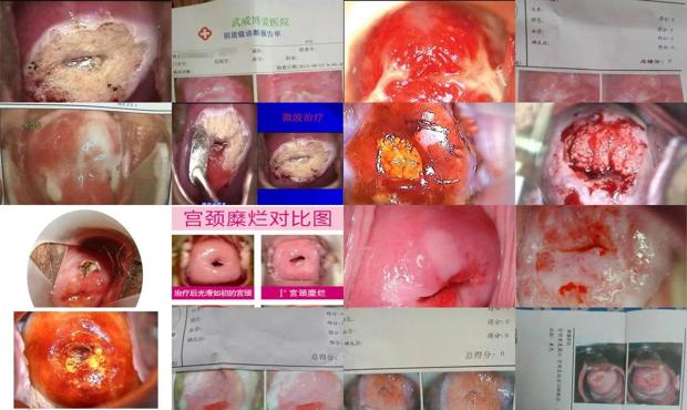 汕头宫颈糜烂图片
