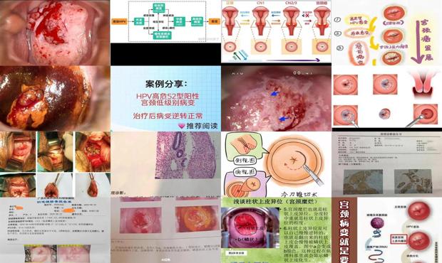 汕头宫颈病变