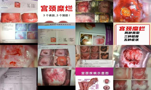 汕头宫颈糜烂的症状