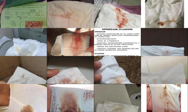 汕头白带带血需要做什么检查