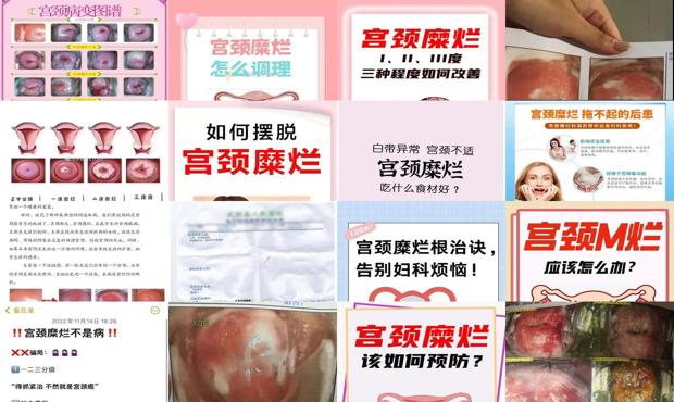 汕头宫颈糜烂怎么根治