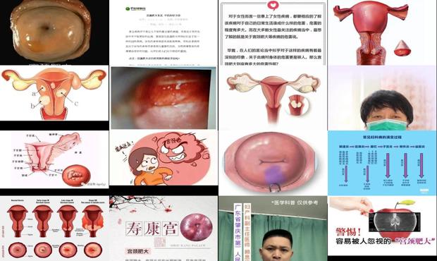 汕头宫颈肥大是怎么回事