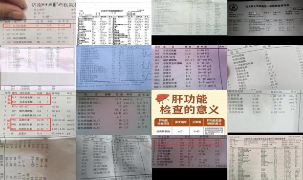 汕头肝功检查有哪些项目