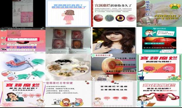 汕头宫颈糜烂怎么自愈