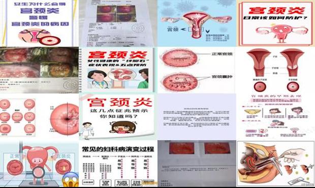 汕头宫颈炎怎么造成的