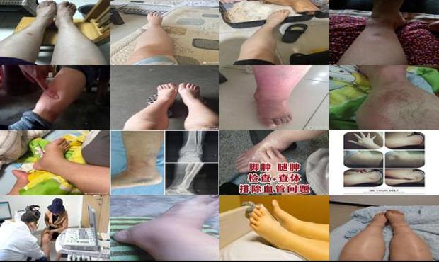 女人腿肿了是什么征兆用什么草药 - 汕头女人腿肿应该检查什么