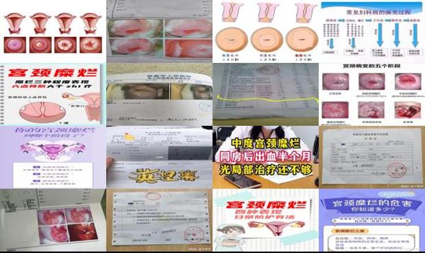 宫颈糜烂有哪些症状 - 汕头中度宫颈糜烂多少钱