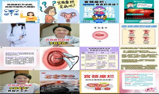 汕头宫颈糜烂可以自愈吗