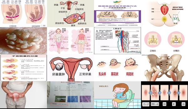 大腿疼是妇科病吗 - 汕头阴道,大腿痛,是妇科炎症引起的吗