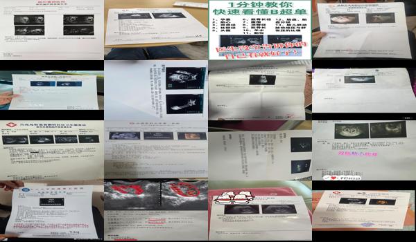 汕头彩超价格表 - 汕头彩超能检查出什么怀孕