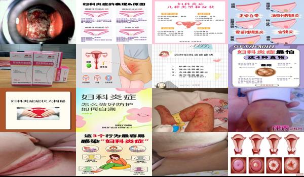 小孩妇科炎症症状图片怎么治疗 - 汕头小孩妇科炎症症状图片