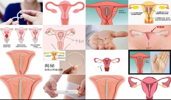 汕头女人上环了会继续怀孕吗多少钱 - 汕头女人上环了会继续怀孕吗